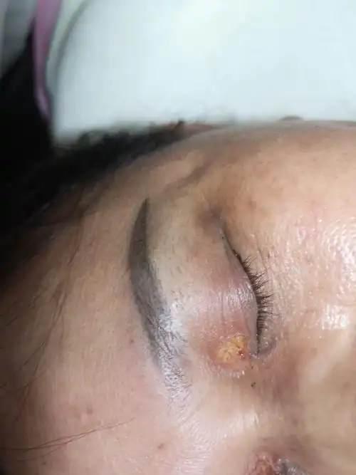 祛睑黄疣真实效果案例