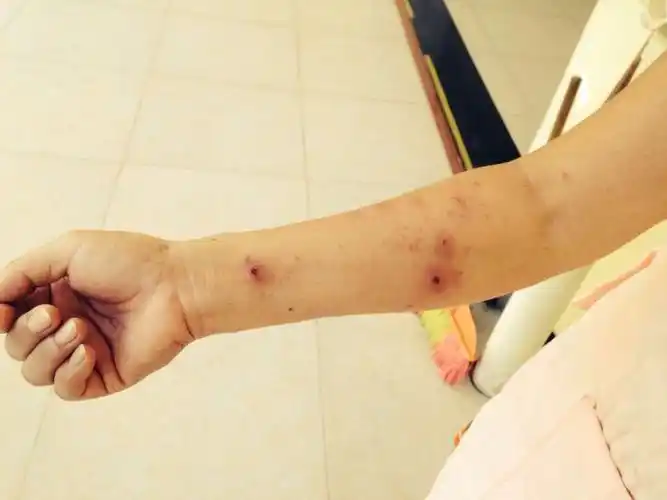 真恐怖啊,我竟被该死的红蚂蚁咬成这个样子了!