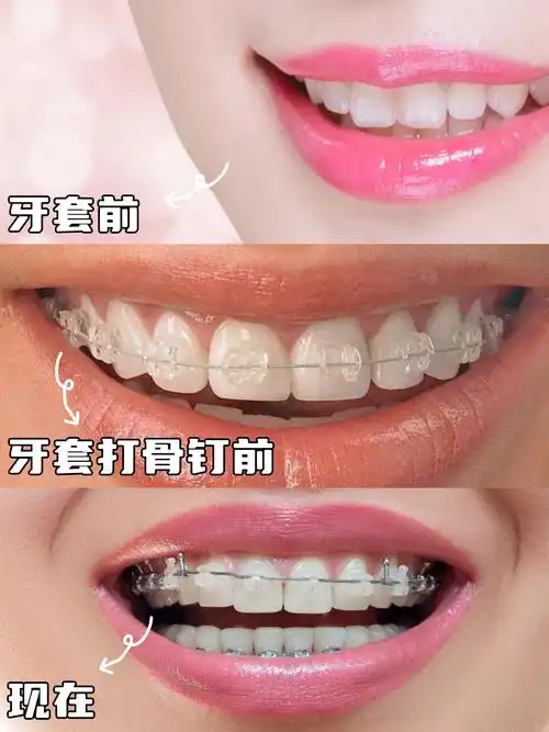矫正牙齿颜值前后变化,说句"换头"也不夸张 矫正牙