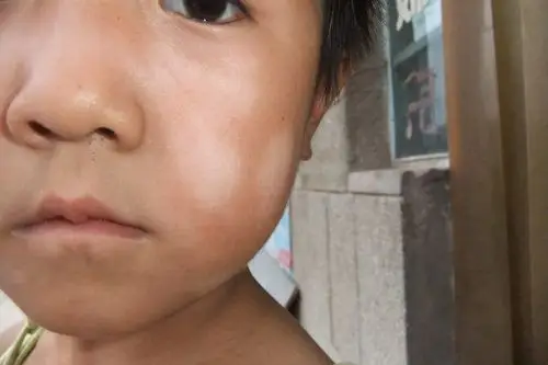 可过去一个多月了,竹竹脸上的斑点不仅没有消失,反而还越来越多了.