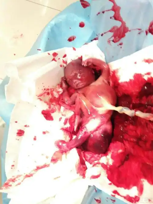 引产畸形2例 [病例帖]