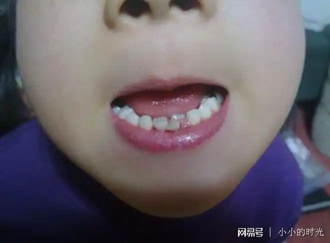 孩子满口牙齿又丑又龅只因孩子常做这事妈妈表示很牙