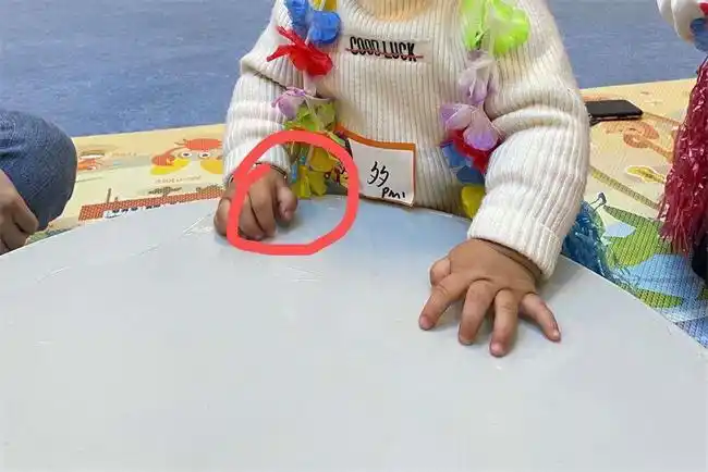 宝宝拇指内扣的原因是什么?有三种情况还需要分辨