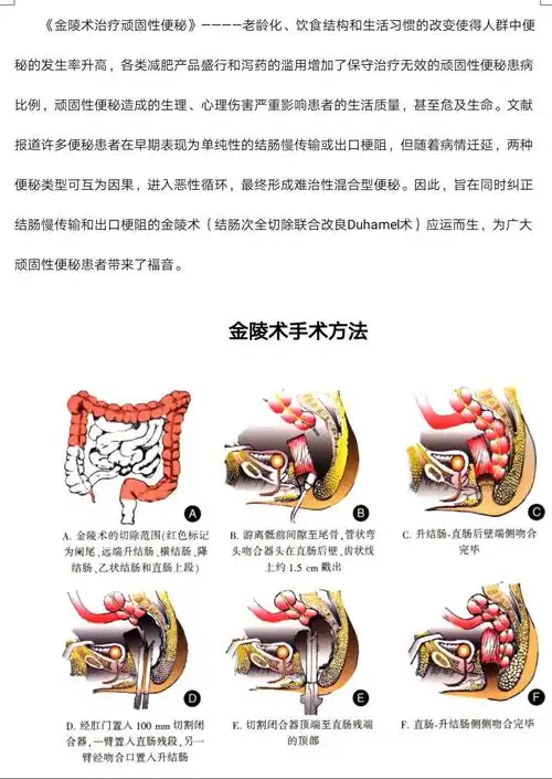 专门为便秘患者设计的手术方式