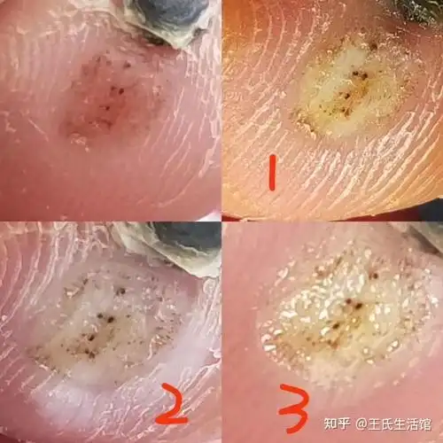 跖疣黑根 - 知乎