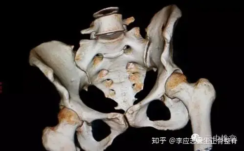 髂嵴最高点在哪里_骶髂关节错位的科普