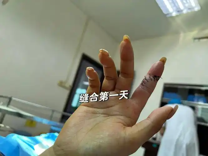 缝合技术  #手缝针