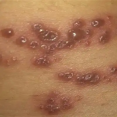 带状疱疹结痂后怎么办