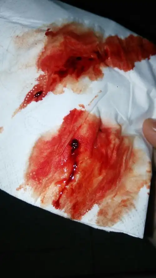 月经来潮,会有这样的血块正常吗?是什么原因导致的,我每天都换