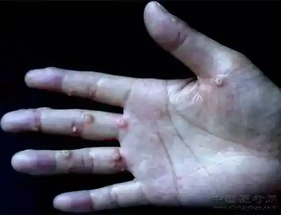 24.手掌部多发疣