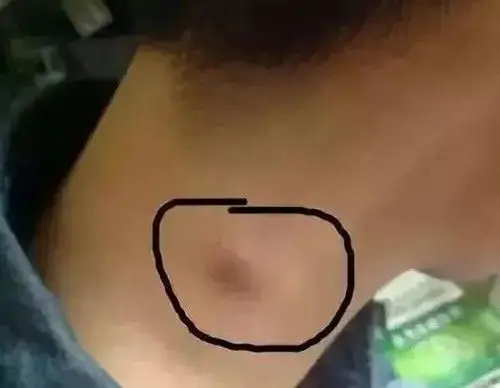 张明辉医生:淋巴结肿大是怎么回事呢?