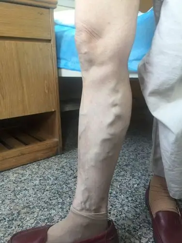 下肢浅静脉曲张也可以不手术 - 好大夫在线