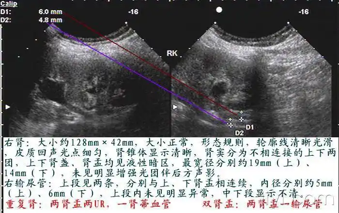 右侧重复肾1例图片集 - 超声医学讨论版 - 爱爱医医学论坛