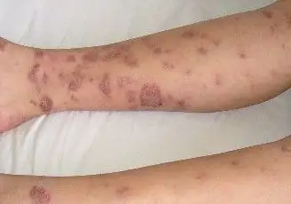 潍坊市市立医院-潍坊血管病|潍坊静脉曲张治疗|潍坊下肢血管病康复