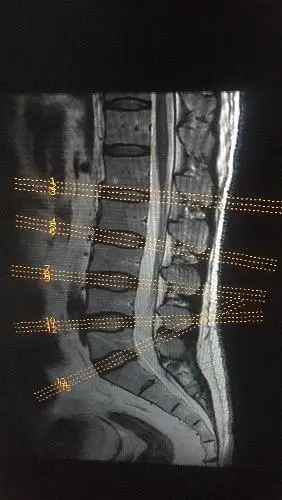 ge mri腰椎拍片定位线