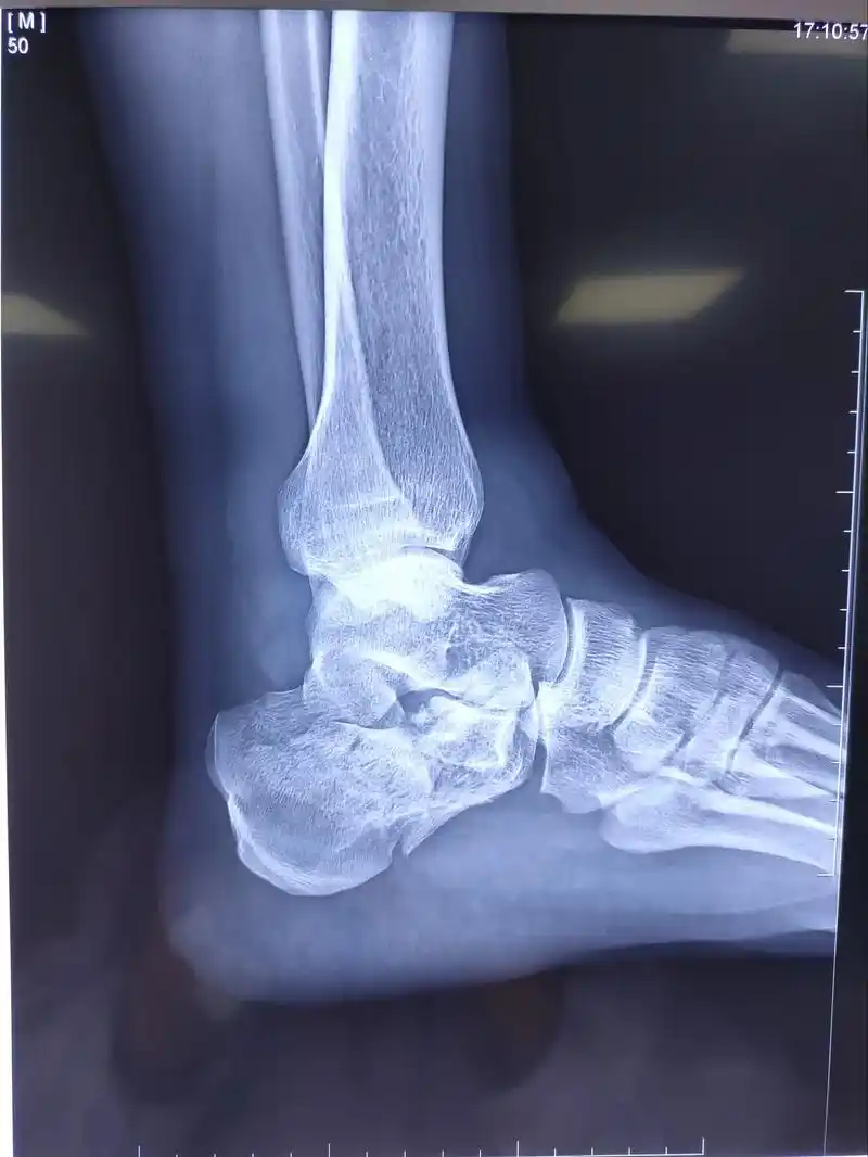 跟骨骨折也就是"脚后跟骨折",是骨科常见的骨折之一.对于严重 - 抖音