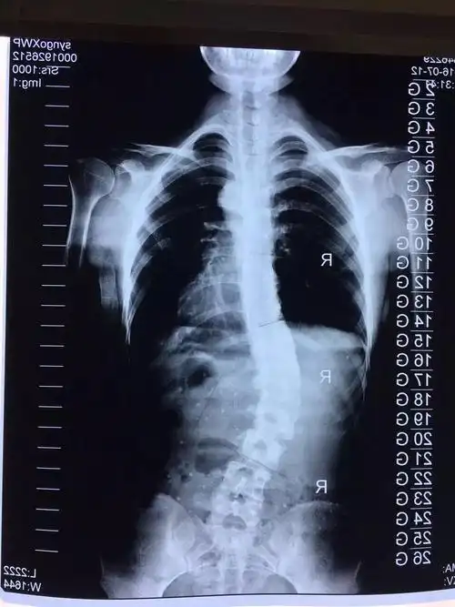 青少年特发性脊柱侧弯之lenke5型