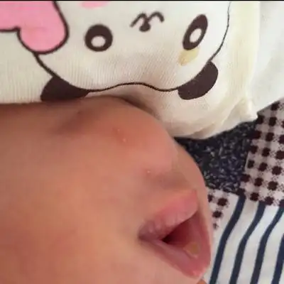 宝宝22天了 下巴颏儿长了好几个粉刺疙瘩. 请问谁知道怎么回事嘛