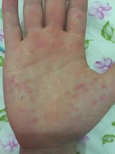 手掌上有红斑!请问什么情况!不疼不痒!有大块小块!