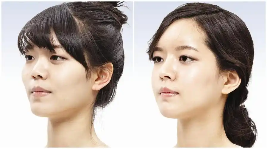 削颧骨前后对比图后遗症注意事项