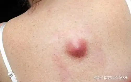 不要忽视身上长出的疙瘩,可能是癌症的预兆|肿块|肿瘤|肿胀|治疗_网易