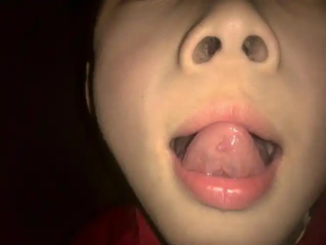 小孩舌头下面长了个肉疙瘩是怎么回事?