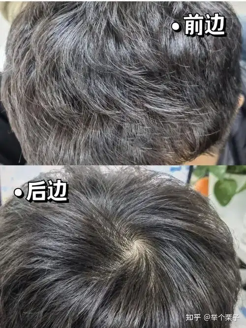 头皮屑多用什么洗发水比较好