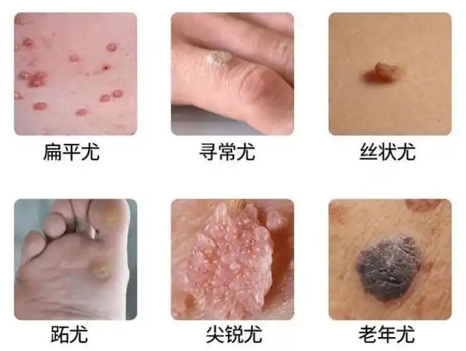 脚上长的这种疙瘩是hpv病毒异变