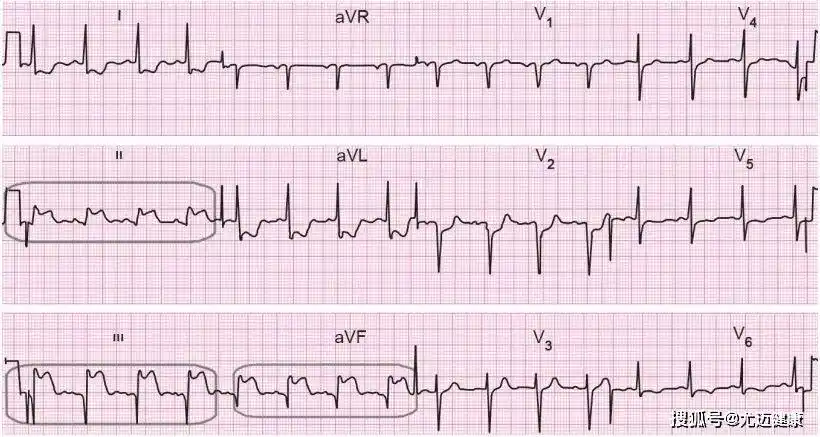 案例分析丨快速掌握急性心肌梗死心电图_诊断_临床_医生