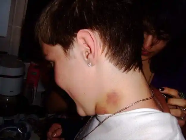 脖子上的草莓是什么,脖子上的草莓是什么时候种的(为何大家都用暧昧的