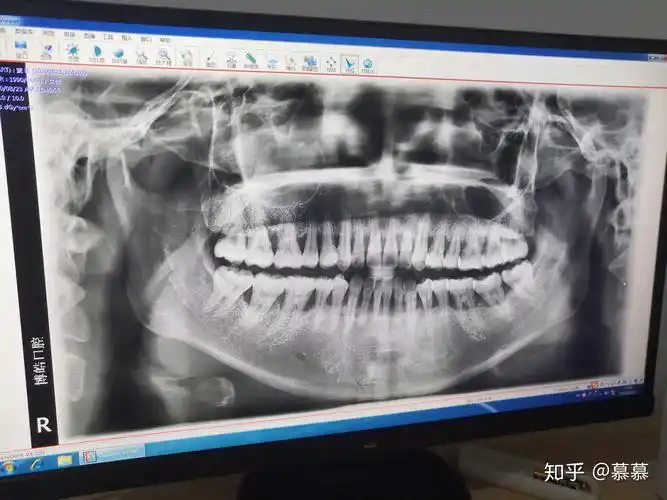 全口牙槽骨吸收