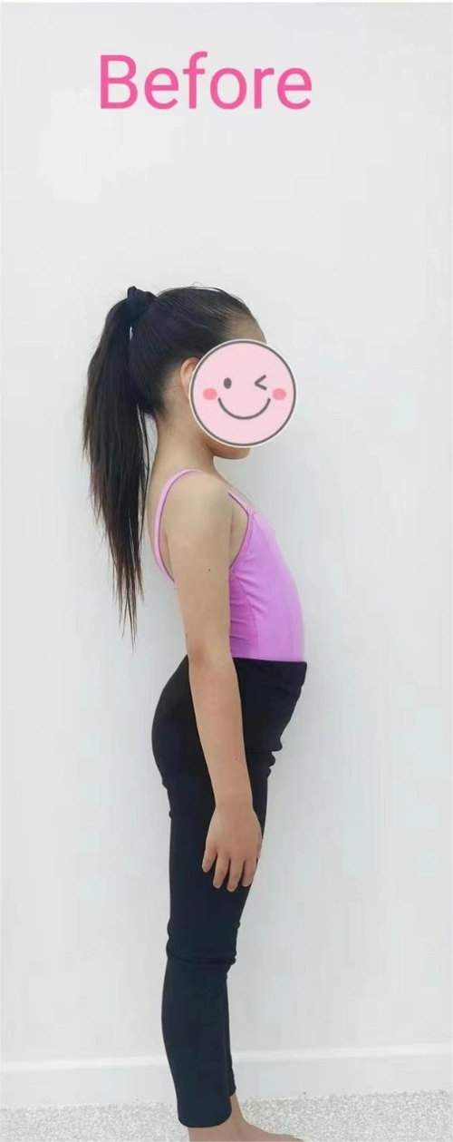 小朋友身材"前凸后翘",挺肚子撅屁股,含胸驼背如何纠正?