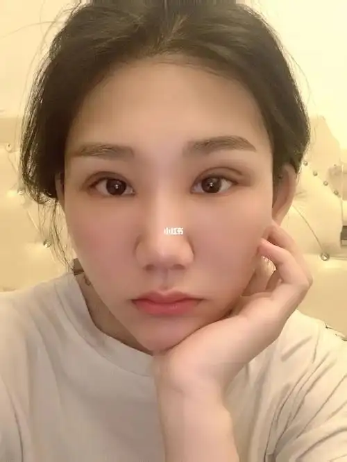 现在眼皮还是麻麻的  期待恢复吧#大眼综合恢复过程  #眼综合