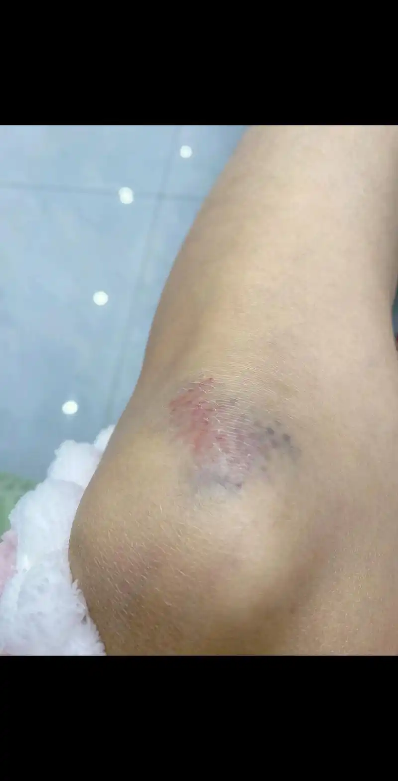 摔一跤青一块紫一块的,还好没事吓死我了. - 抖音