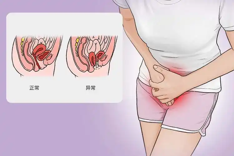 产后尿道口膨出图