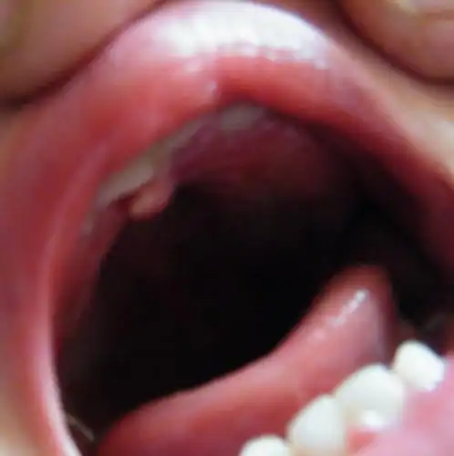 一岁多的宝宝门牙里面的牙龈上长了一块小肉