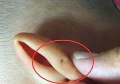 宝宝左耳6个月的时候发炎,引起红肿,还有白色的分泌物流出,当时还以为