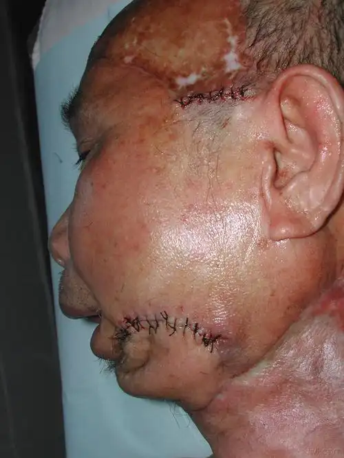 牙龈癌手术前后图