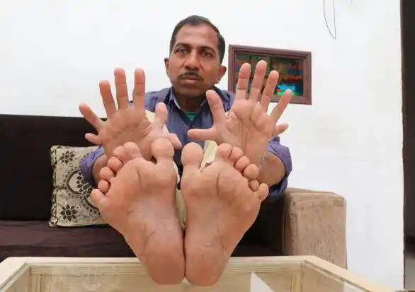 世界上手指和脚趾最多的人28根手指和脚趾