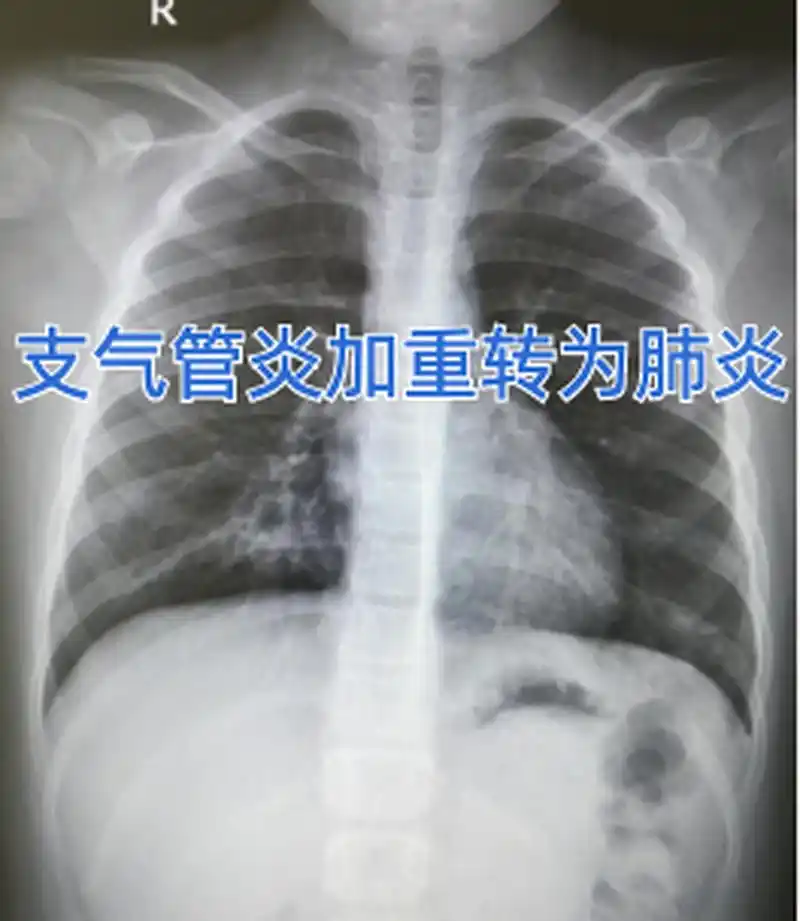 支气管炎加重转为肺炎  小孩今年3岁了,因为在家没人带,所以就把她送