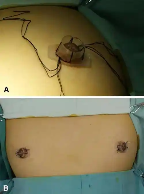 中国研究:乳头牵引器矫正乳头凹陷十年经验分享