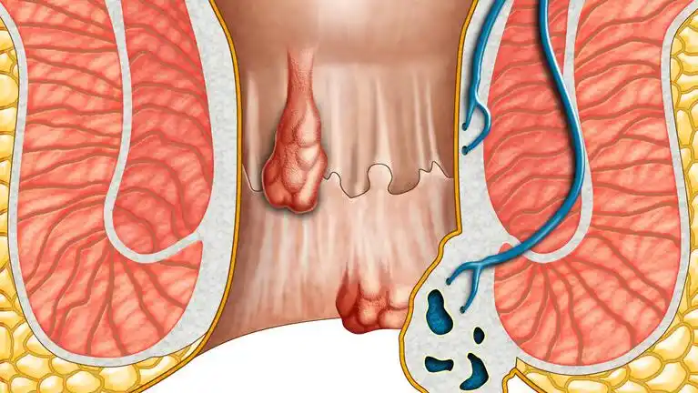痔疮和息肉的区别