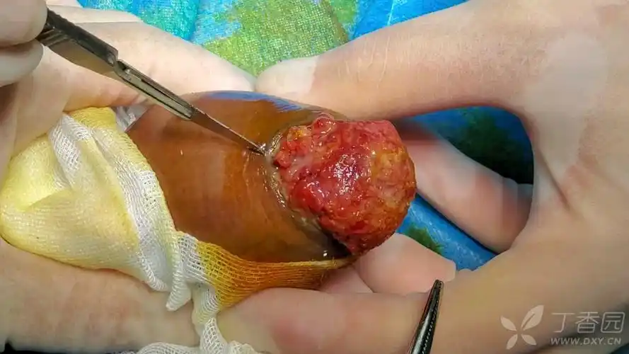 【阴茎ca】阴茎部分切除术次全切 [病例帖]