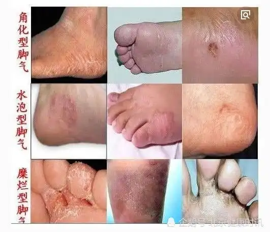 判断三:曾有脚气 皮肤蜕皮 瘙痒 水泡 糜烂蜕皮