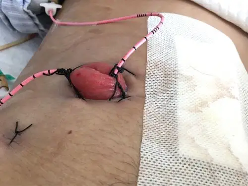 术后第三天,患者已通气,乳头很漂亮!