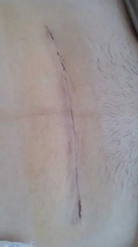 我的剖腹产后第9天的刀疤