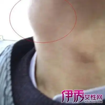 【图】展示颈部淋巴瘤图片 独家揭秘该病的临床表现有哪些?