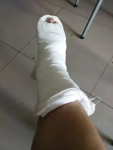 我的右脚踝骨折.