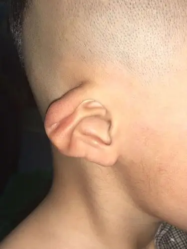 【关注前沿】耳廓再造,让耳朵重新"站"起来