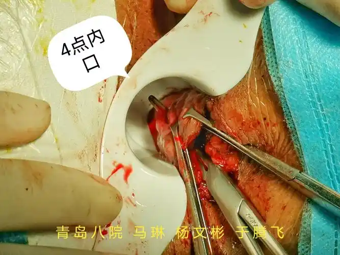 外院pph术累及肛腺,导致术后反复发生肛瘘手术笔记,期待这是最后一次